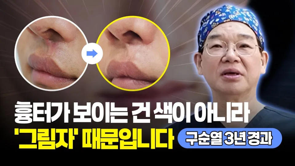 구순구개열 흉터 절개 없이 개선하는 지방이식