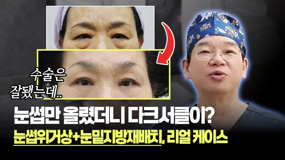 눈썹위거상 1년 이후는..? 눈 수술하고 후회했던 이유 | 눈썹위거상·눈밑지방재배치 전후 | 보니따의원