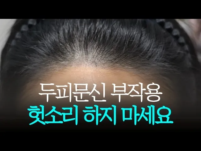 두피문신 부작용과 안전한 시술을 위한 핵심 정보